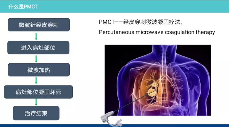 必发9988集团肿瘤二科完成一例恶性肿瘤肺转移高难度微波消融术